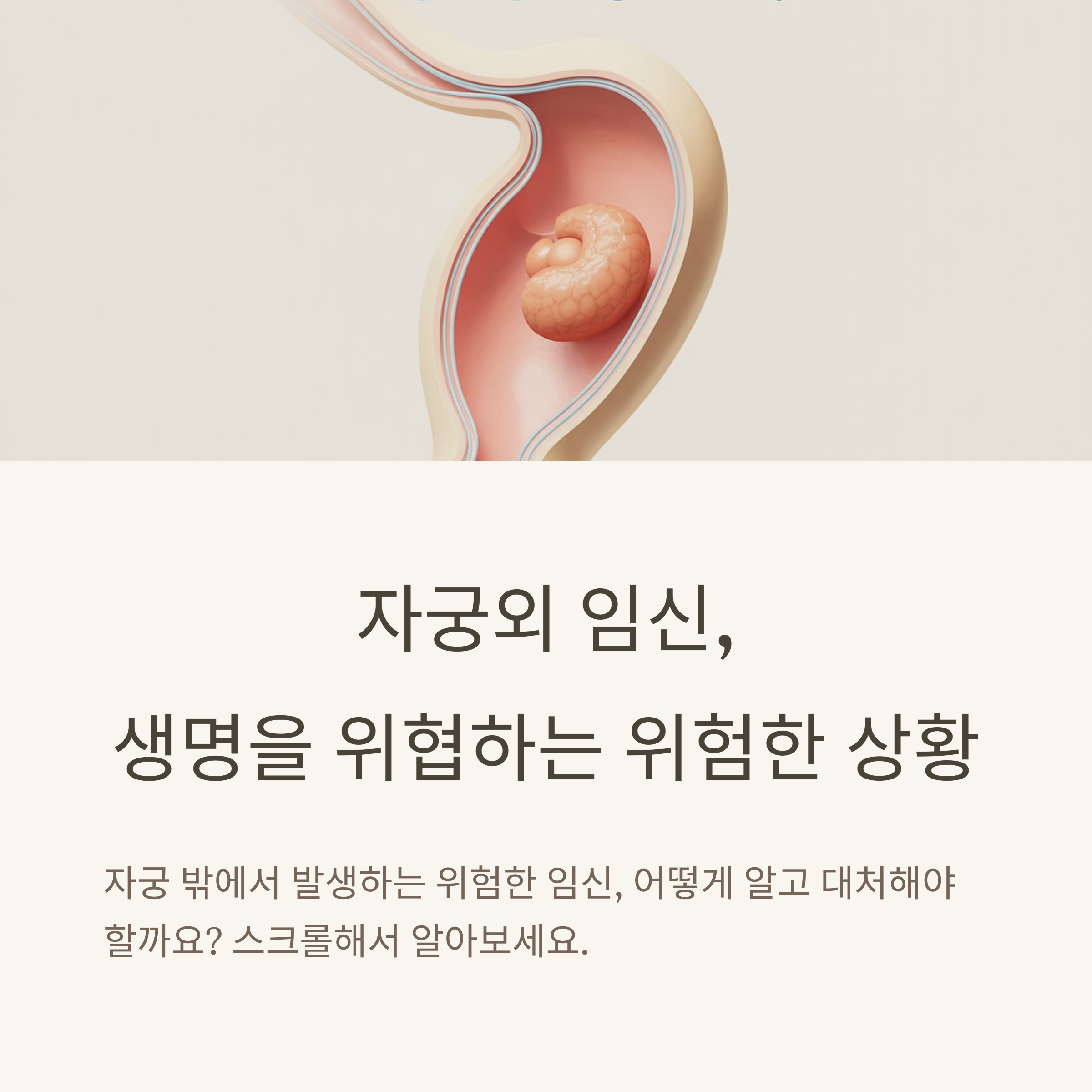 자궁 밖에 위치한 배아의 모습을 담은 이미지와 함께 자궁외 임신의 위험성과 경각심을 주는 문구를 포함한 건강 인식 이미지