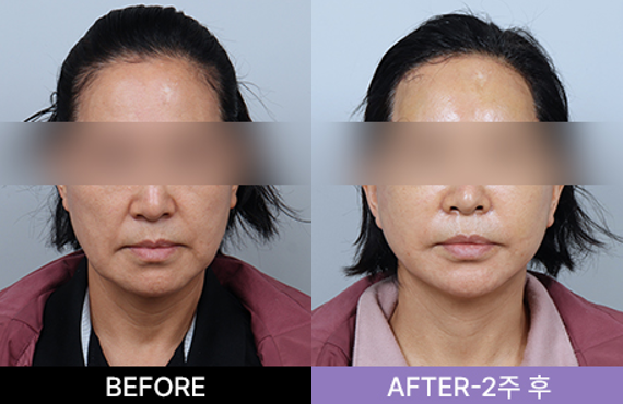 스마일리프팅가격 스마일거상