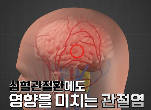 콘드로이친