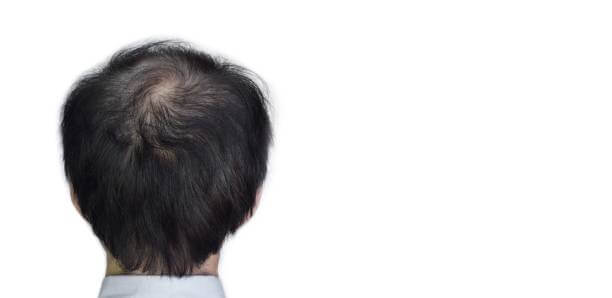 탈모 예방 방법 쉽게 알아보기. 좋은 영양제&amp;#44; 샴푸&amp;#44; 헤어브러쉬