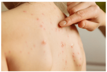 헤르페스 2형 성병 증상