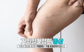 거위발 건염 원인과 증상 무릎 안쪽 통증 치료법 정리_13