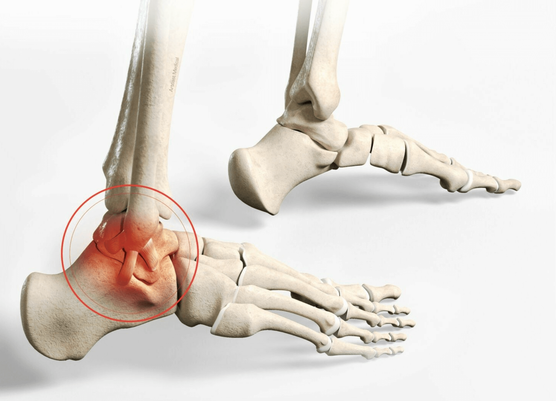 발목 인대 파열