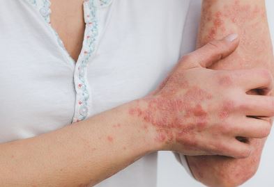 대상포진 초기증상