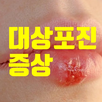 대상포진 초기증상 원인