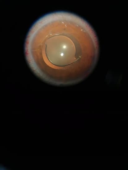 인공 수정체 (IOL, Intraocular Lens): 백내장 수술의 핵심 요소