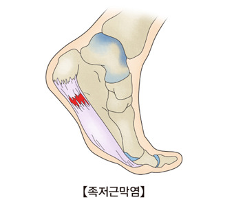 족저근막염
