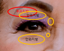 루프지방과 안와지방 위치