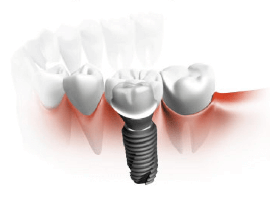 치아에 식립되어 있는 임플란트 치아