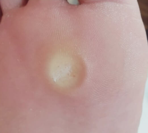 티눈-없애는-방법