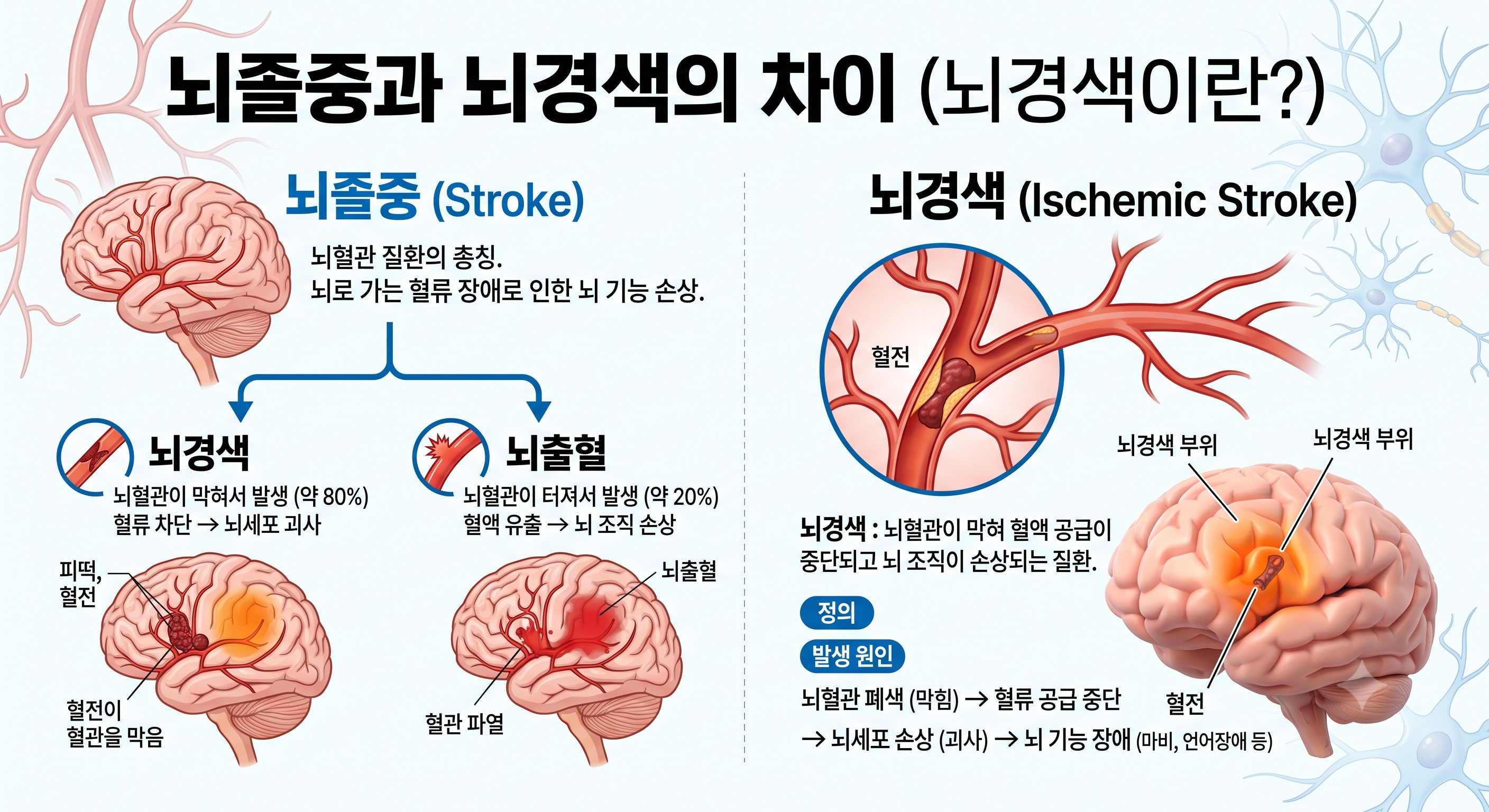 뇌경색이란
