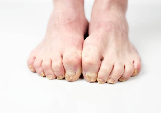 발톱무좀이 있는 발