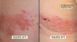 대상포진5