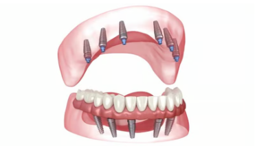 전체 임플란트 장단점
