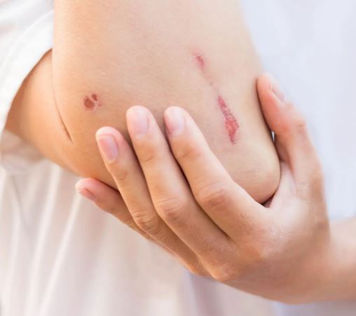 피부에 상처가 나서 파상풍 위험에 노출된 사진