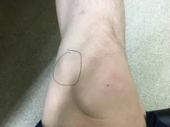 거위발 건염 원인과 증상 무릎 안쪽 통증 치료법 정리_18