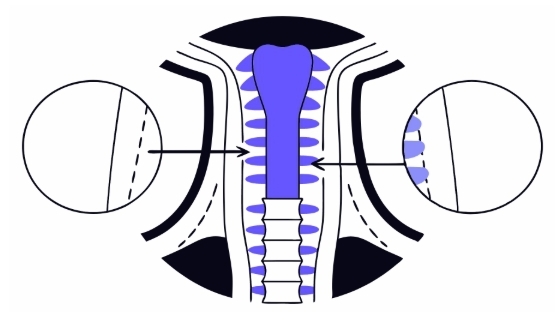 인두암 수술과정