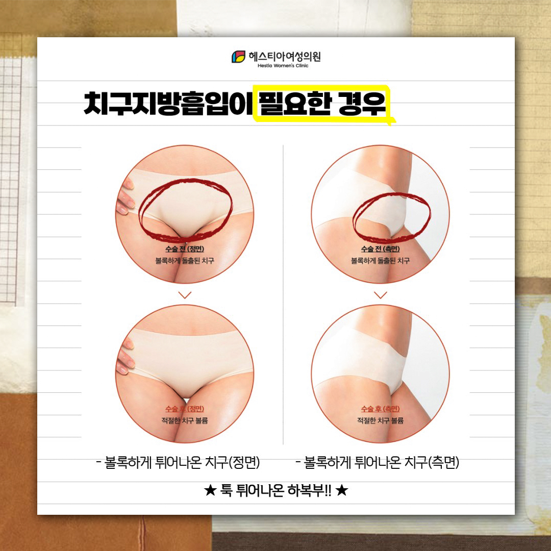 치구지방흡입이 필요한 경우