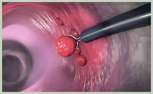 대장내시경 검사 주기