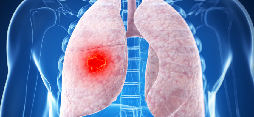 객혈이 발생할 때 의심할 수 있는 질병