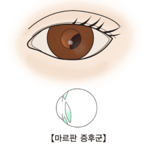 마르판 증후군