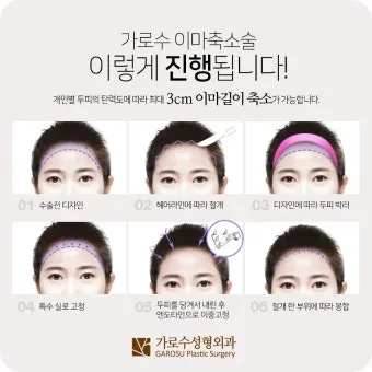 이마가 넓은 여자 관상 특징과 해석_4