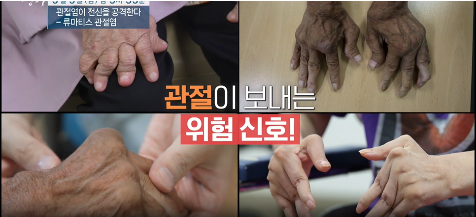 명의-류마티스 관절염이 전신을 공격한다