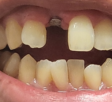 안니 임플란트 치료