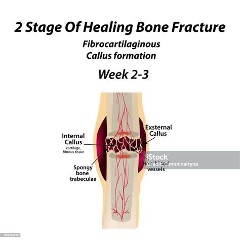 뼈골절 수술비용