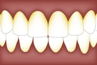 박테리아가-있는-치아상태