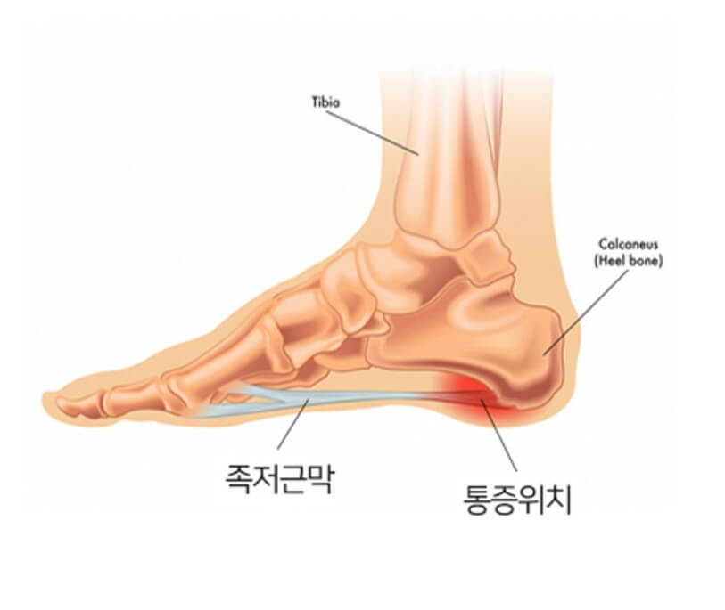 족저 근막염 통증 위치