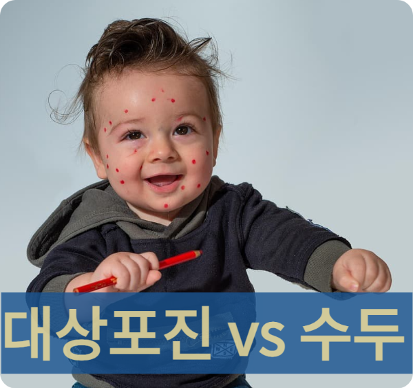 대상포진과 수두 차이, 뭐가 다를까? 헷갈리는 질환 비교