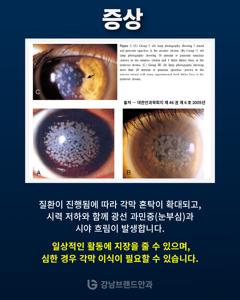 각막혼탁