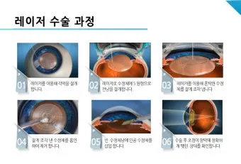 백내장 수술 비용 실비 보험 청구 회복기간_9