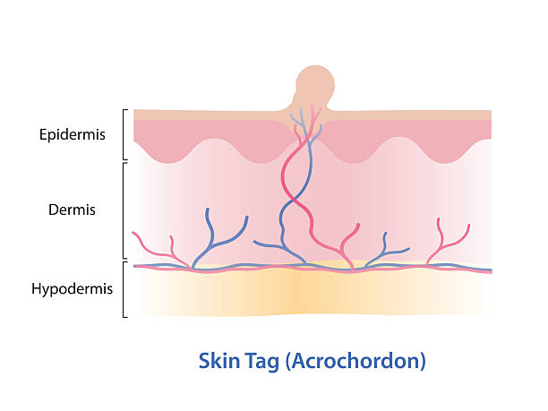 목에 쥐젖이란 의학적으로 연성섬유종이라 불리며 피부표면에 작게 돌출된 양성 종양이다
