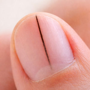 손톱에 검은줄세로줄이 생기는 이유