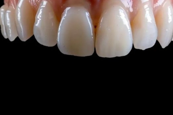 이빨 흔들리는 꿈