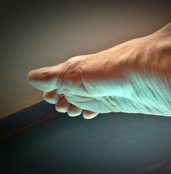 발바닥 화끈거림 원인과 증상 대처법 사진 9