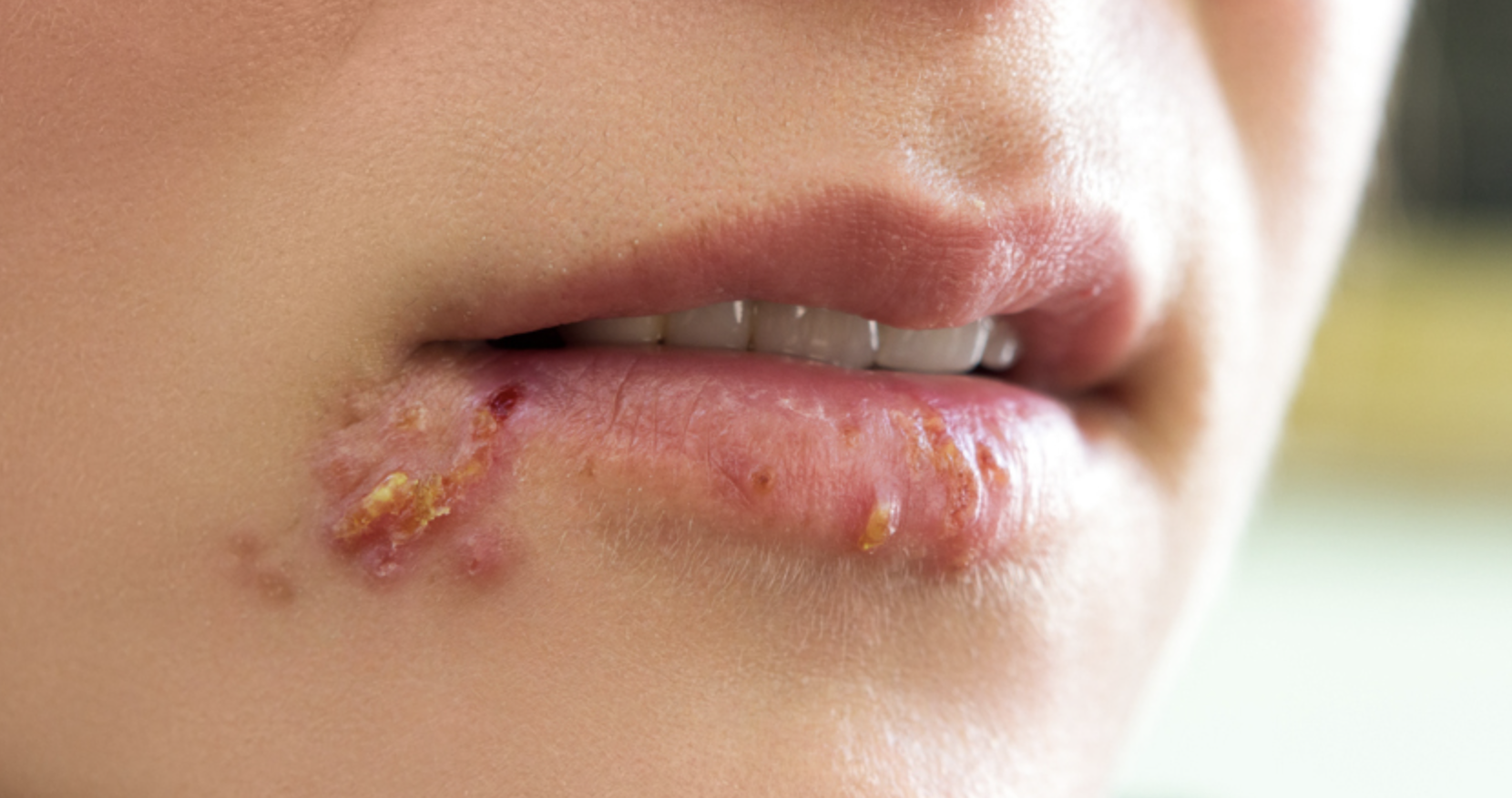 헤르페스 입술포진