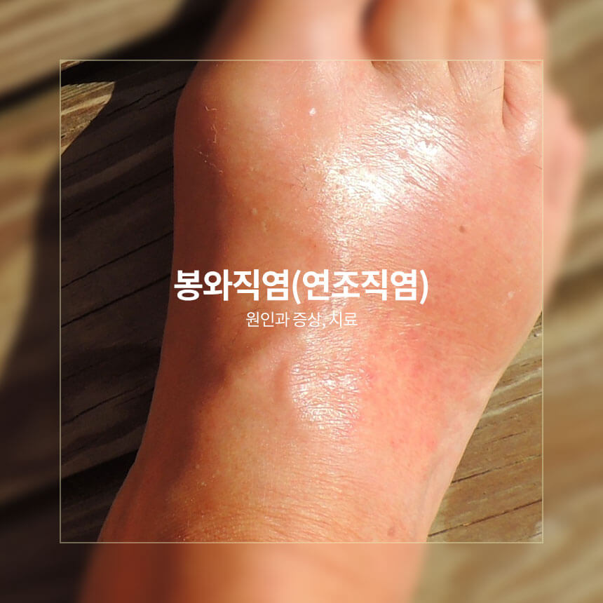 봉와직염, 연조직염 원인과 증상, 치료