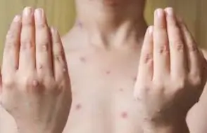 대상포진 예방접종 무료대상ㅣ초기증상 부작용