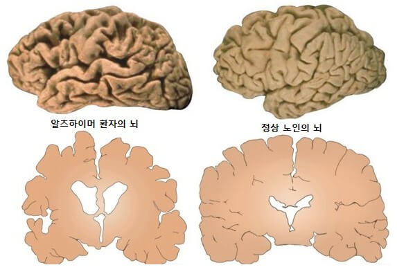 뇌노화