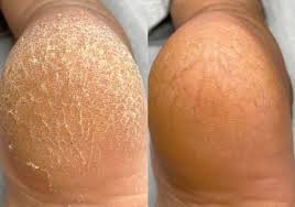 티눈이 생기는 이유