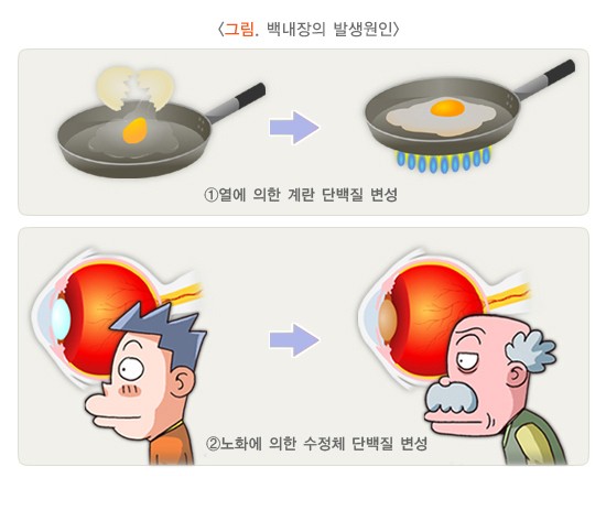 백내장