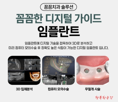 꼼꼼치과 임플란트 가격