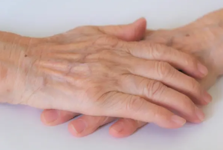 손가락이 구부러지지 않게 되는 헤버든 결절