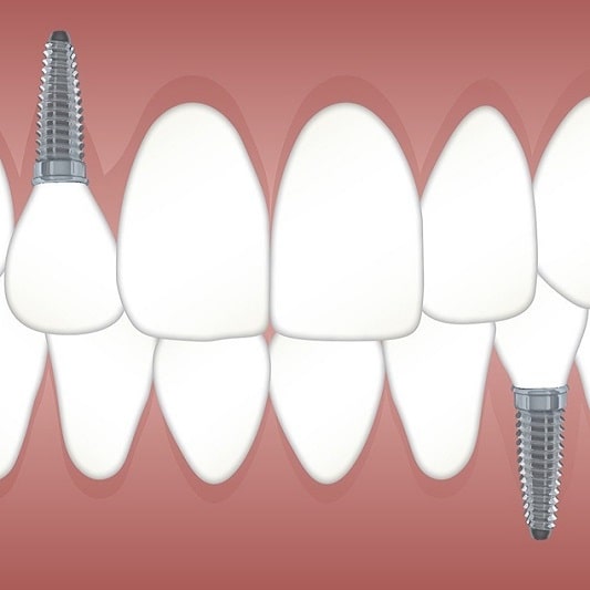 65세 이상 임플란트