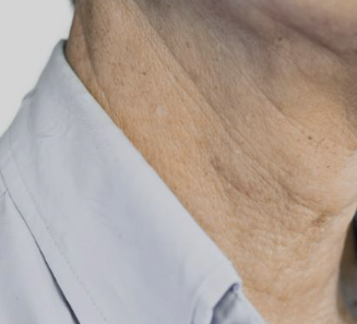 목주름 없애는 운동 알아보기&amp;#44; 목주름 원인