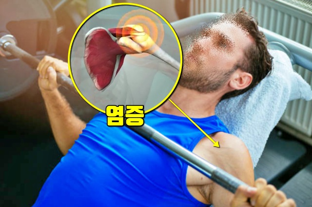 어깨통증 원인, 회전근개건염 증상 치료 좋은 어깨 운동,건강 팁줌 매일꿀정보