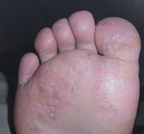 무좀약 PM 피엠 외용액 바르고 왜 발껍질이 벗겨지지?